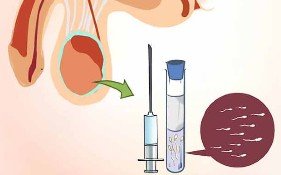 TESA - Testicular Sperm Aspiration